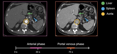 Abdominal CT: Phases • LITFL • Radiology library