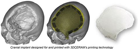 Additive Manufacturing of Ceramics for Biomedical Applications - Sinto ...