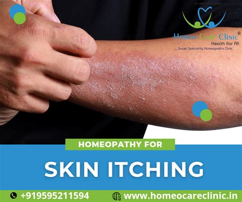 Best Homeopathic Treatment For Skin Itching Safe And Effective