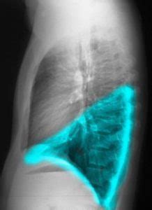 Chest X Ray Lung Parts And Fissures CXR Lungs