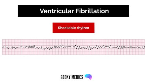 Shockable vs. Non-shockable Rhythms in Cardiac Arrest | Geeky Medics