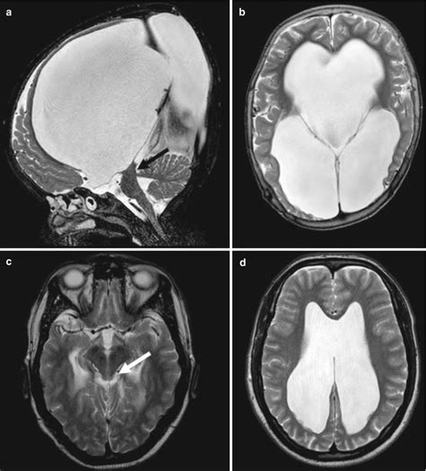 Hydrocephalus In Children Springerlink