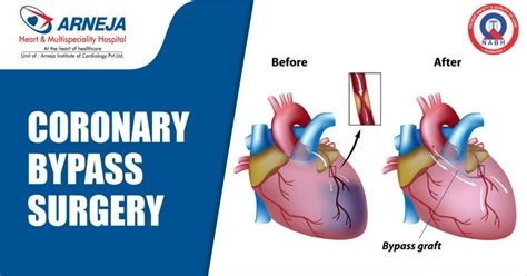 Know About Coronary Bypass Surgery - Arneja Heart And Multispeciality Hospital | World-Class ...