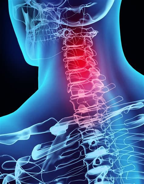 300 Whiplash Patients Get Help With Upper Cervical Chiropractic Nucca National Upper