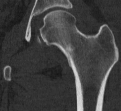 Femoral Neck Stress Fracture MRI