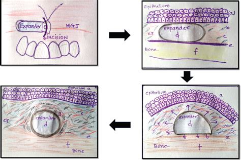 Intraoral Tissue Expander Tissue Augmentation For Deficient Alveolar Ridge By