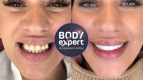 Refaire Ses Dents Les Solutions Possibles Et Leurs Prix Body Expert