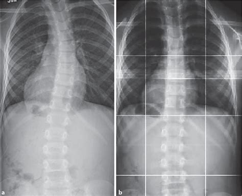 Figure 1 From Effect Of Posterior Fossa Decompression For Chiari Malformation I On Scoliosis