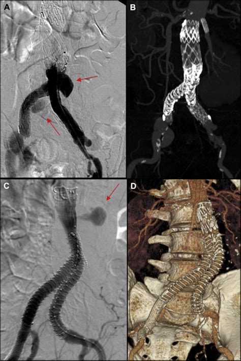 The Diagnostic And Treatment Challenge Of Type Iiib Endoleaks Journal