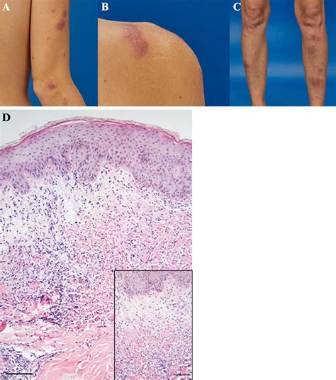 Erythema Nodosum Oorzaken Symptomen Behandeling