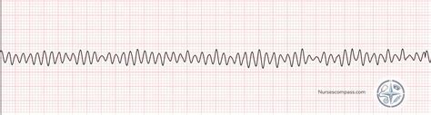 ekg interpretation guide learn  read heart rhythms step  step