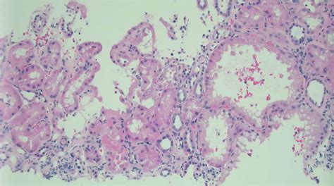 A Case Of Comma Shaped Fibrillary Glomerulonephritis Diagnostic