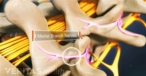 Medial Branch Nerve Blocks