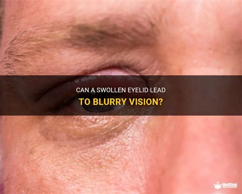 Can A Swollen Eyelid Lead To Blurry Vision Medshun