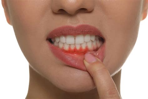 Cómo curar encías retraídas Clínica Dental Sedano