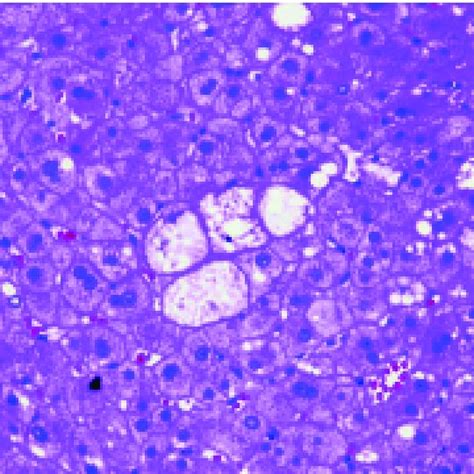 (PDF) NASH and cryptogenic cirrhosis: A histological analysis