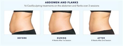 DIY CoolSculpting | The Dangers of CoolSculpting at Home