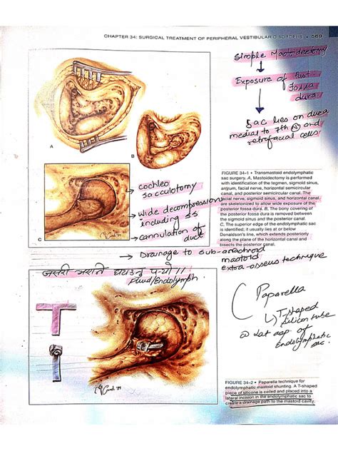 Endolymphatic Sac Surgery Pdf