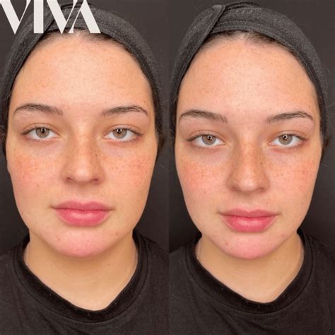 What Is Facial Contouring VIVA Skin Clinics Blog