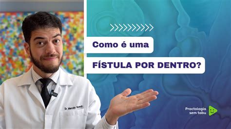 Como é Uma Fístula Perianal Por Dentro Youtube