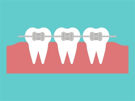 Vector Ortodontia Dente Com Aparelho De Metal E Sistema De Suporte