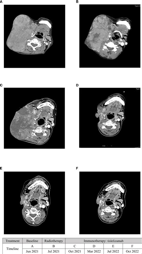 Frontiers Radiotherapy Combined With Immunotherapy Successfully