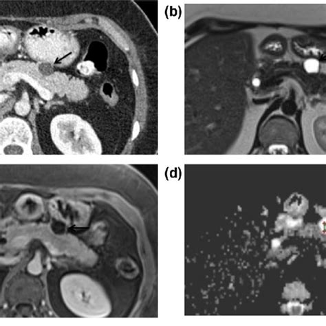 Mucinous Cystadenoma A Axial Ct Venous Phase Revealed A Small Cyst At