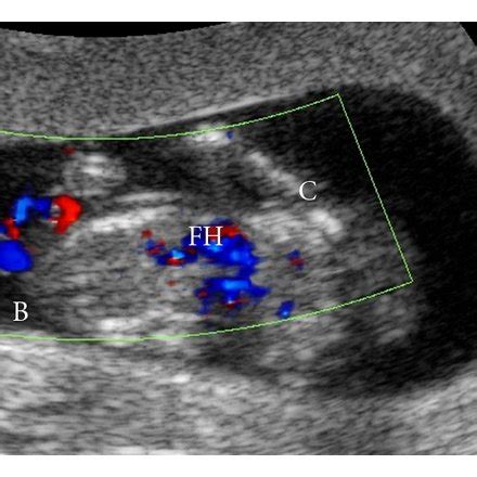 MRI images of conjoined twins in a triplet pregnancy. | Download ...