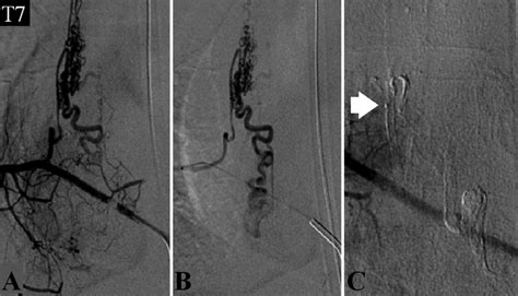 A Superselective Spinal Angiogram Of The Right T Radiculomedullary