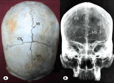 A Superior View Of The Skull Showing The Metopism B Anteroposterior