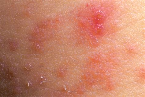 Does Allergy Immunotherapy Have A Role In Atopic Dermatitis Advances In Dermatology