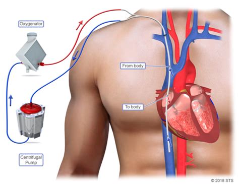 Vv Ecmo Newport Cardiac And Thoracic Surgery