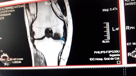 Resonancia Magn Tica Rodilla Derecha Youtube