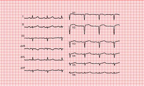 Anterior Myocardial Infarction Ecg