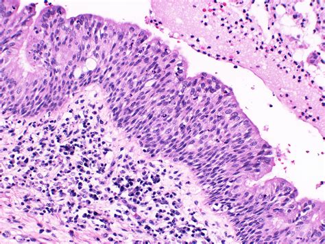 Difference Between Metaplasia And Dysplasia Metaplasia Vs Dysplasia