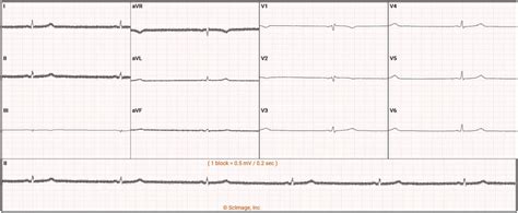 ECG demonstrating sinus bradycardia. | Download Scientific Diagram