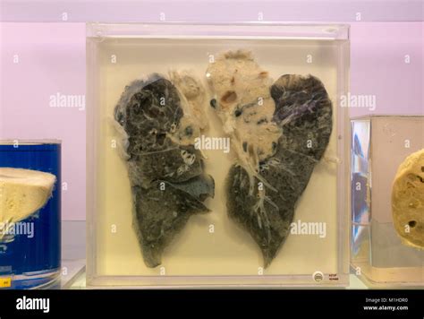 Smokers Lungs Hi Res Stock Photography And Images Alamy