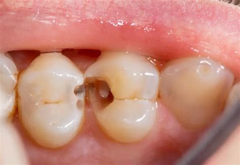 Partial Pulpotomy Better In Terms Of Clinical And Radiographic