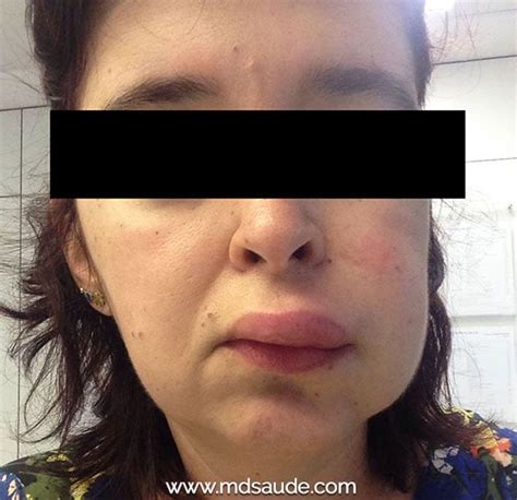 ANGIOEDEMA O que é causas sintomas e tratamento