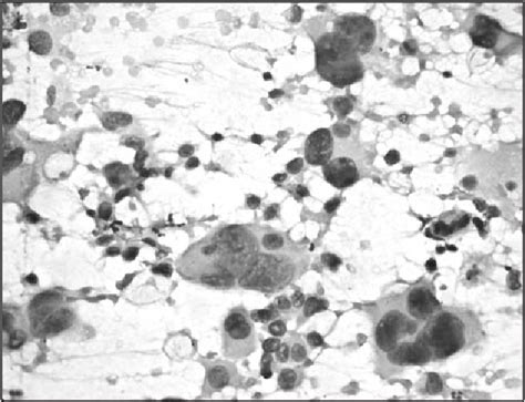 Figure 2 From Fine Needle Aspiration Cytology Of Mammary Carcinoma With