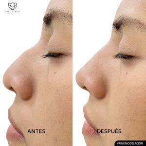 Rhinoplasty Nose Surgery English Speaking Plastic Surgery In Lima Peru