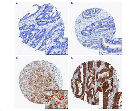 Representative Immunohistochemical Maspin Protein Stains Showing Four