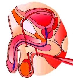 Actualit S Contraception R Versible Par Voie Locale Vasalgel R