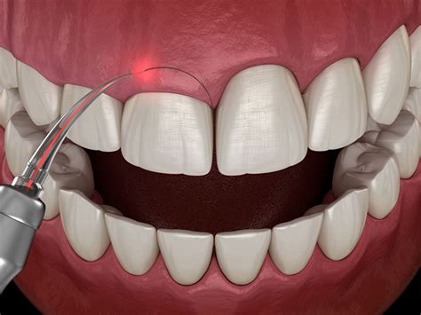 Qué es la gingivectomía Clínica Dental Clavell