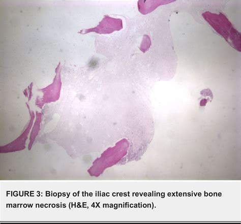 Figure 1 From Extensive Bone Marrow Necrosis And Osteolytic Lesions In