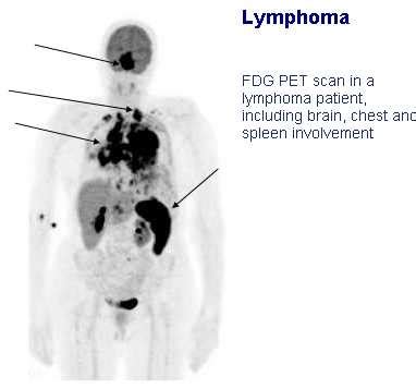 Pet Scan Lymphoma Stage Iv