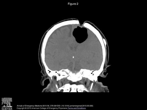 Spontaneous Tension Pneumocephalus Resulting From A Scalp Fistula In A