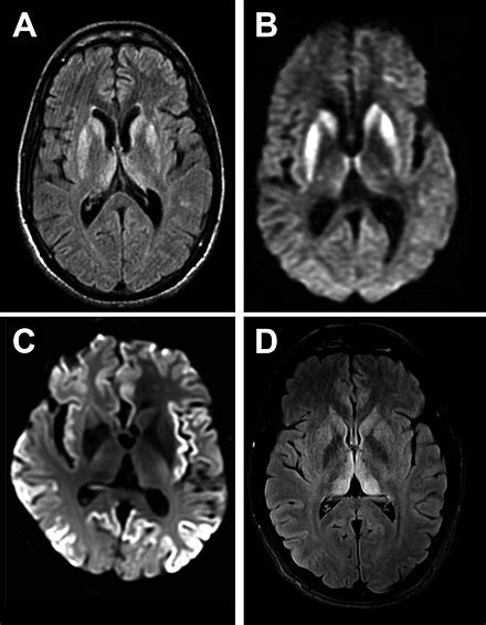 Creutzfeldt–Jakob disease - Wikiwand