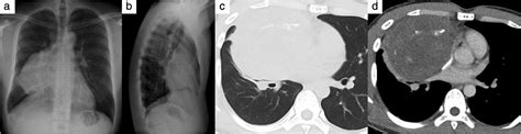 Mixed‐type Primary Germ Cell Tumor Of The Mediastinum In A Young Adult