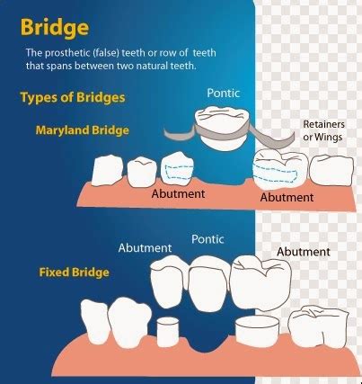 Omni Dental Group: Maryland Bridge (Bonded Resin Retainer)